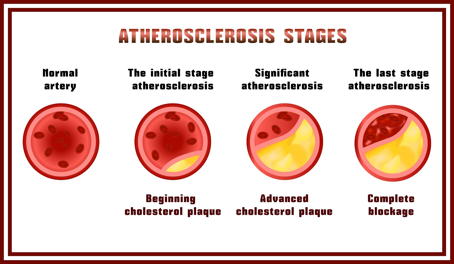 Štádia aterosklerózy